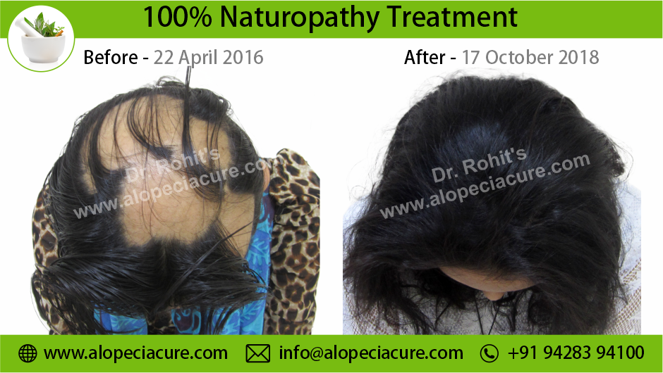 alopecia areata treatment Surat